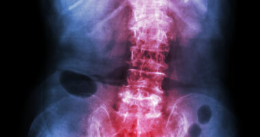 Xeljanz, ankylosing spondylitis