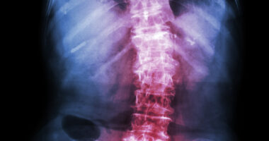 Xeljanz, ankylosing spondylitis