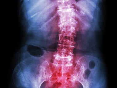 Xeljanz, ankylosing spondylitis