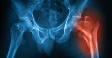 hip replacement surgery