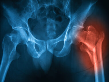hip replacement surgery