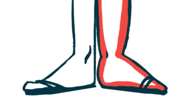 bone formation ankylosing spondylitis | Ankylosing Spondylitis News | illustration of foot and ankle symptoms