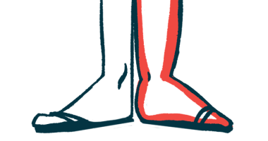bone formation ankylosing spondylitis | Ankylosing Spondylitis News | illustration of foot and ankle symptoms