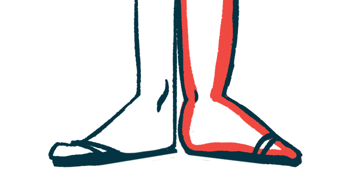 bone formation ankylosing spondylitis | Ankylosing Spondylitis News | illustration of foot and ankle symptoms